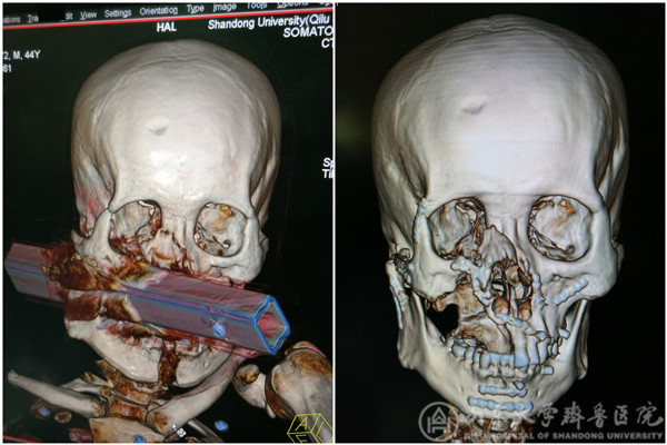 面部钢管贯通伤患者顺利出院