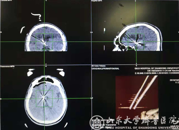 手术机器人系统在神经外科首次亮相--机器人辅助立体定向脑电图引导下射频热凝术取得理想效果