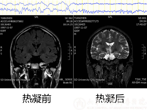 手术机器人系统在神经外科首次亮相--机器人辅助立体定向脑电图引导下射频热凝术取得理想效果