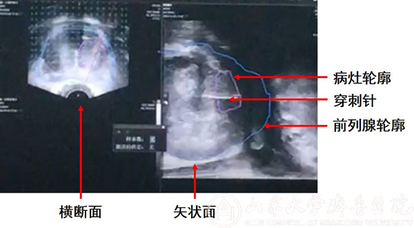 使前列腺癌看得见 能追踪--磁共振融合前列腺靶向穿刺助力前列腺癌的精准诊断