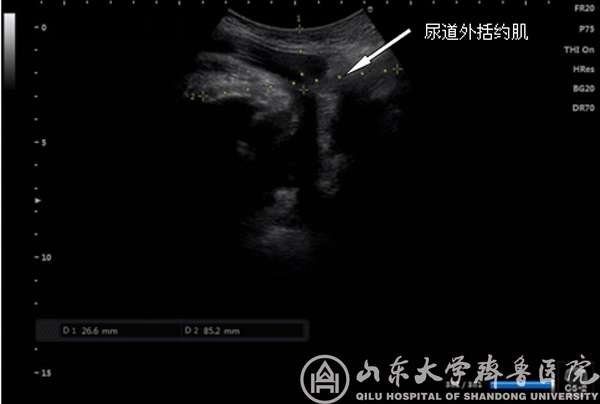 超声引导下尿道外括约肌肉毒毒素注射治疗尿潴留效果好