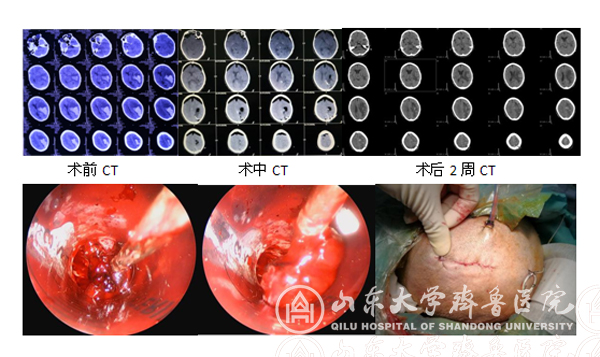 我院采用神经内镜微创手术救治一例脑疝脑出血老人