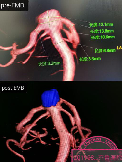神经外科成功完成国内首例Neuangio 30C上的基底动脉动脉瘤Y形支架辅助栓塞术