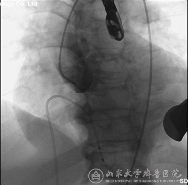 心外科应用TAVI微创技术成功挽救左心室射血分数仅为0.17的病危患者