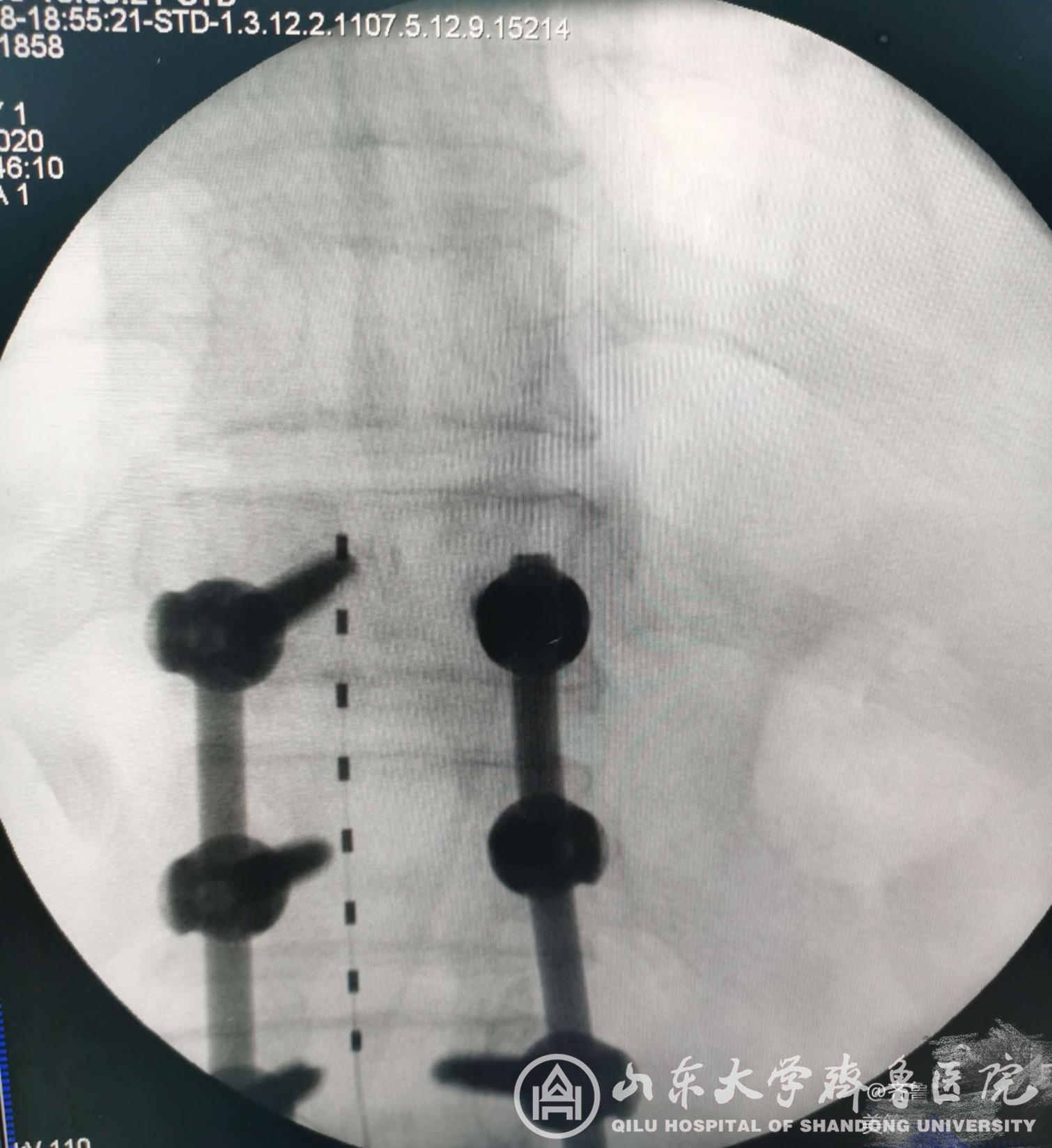 齐鲁医院疼痛科成功实施永久性脊髓电刺激术治疗顽固性疼痛患者