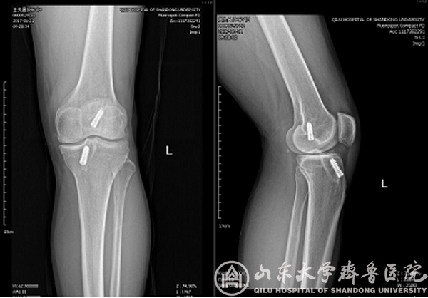 青岛院区成功实施全国首例前交叉韧带翻修+胫骨高位截骨二合一手术