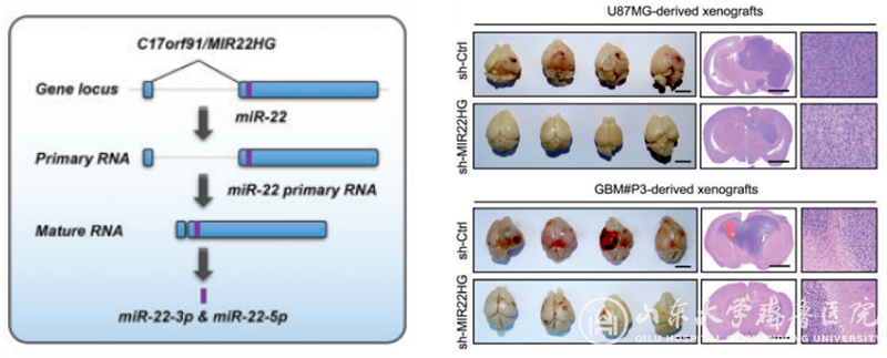 山东大学脑科学团队在胶质瘤lncRNA相关研究领域取得新进展
