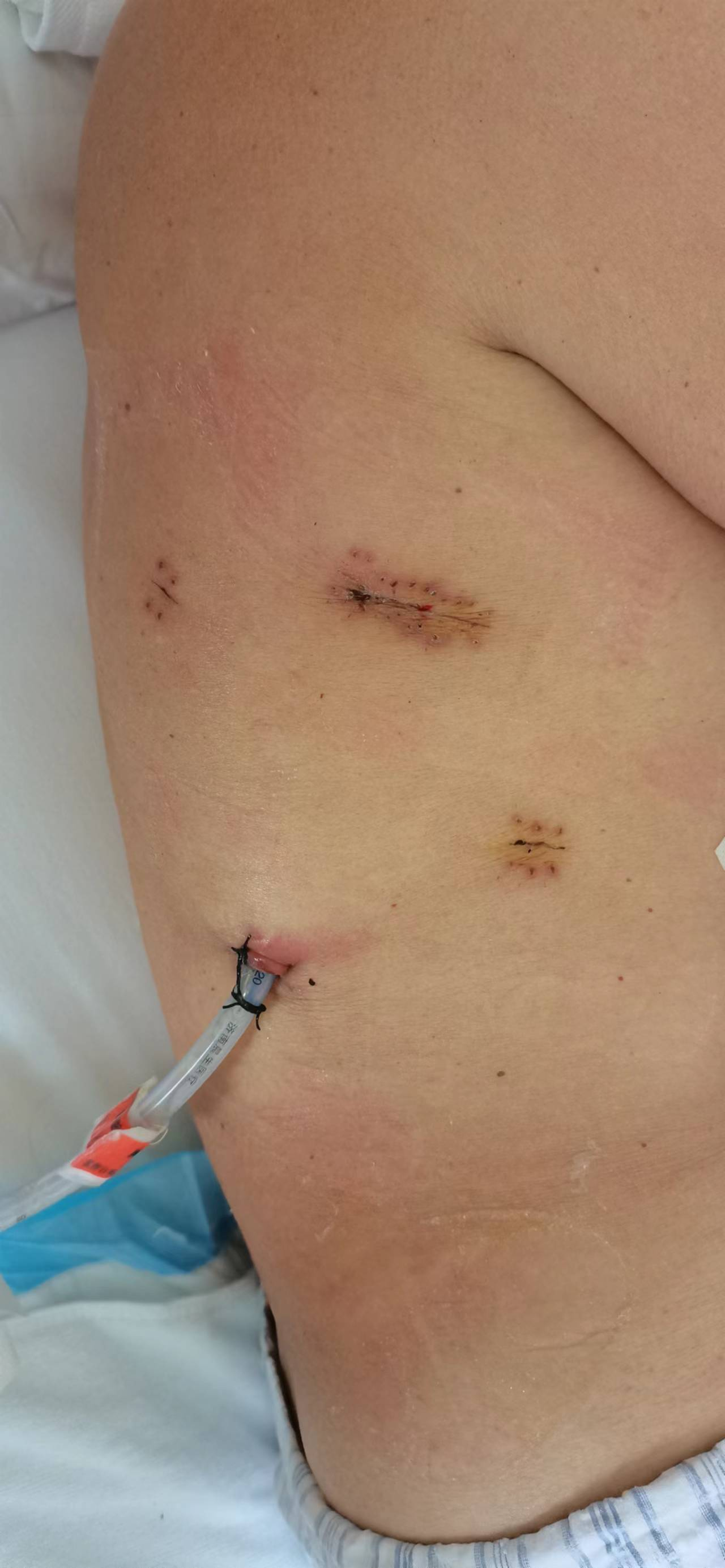 胃手术伤口图片女生图片